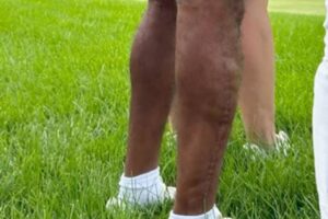 Tiger Woods, Pierna Tiger Woods,